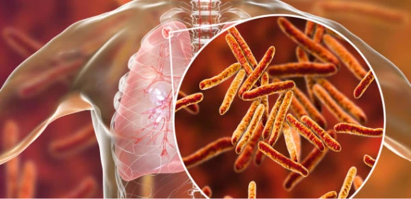 Tuberculosis